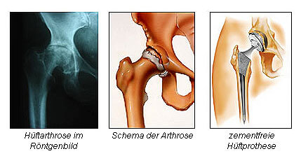 Bild 1 | Arthrose 